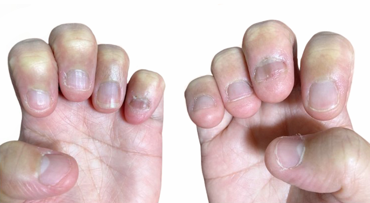 添付ファイル用参考写真 両手の爪を写す