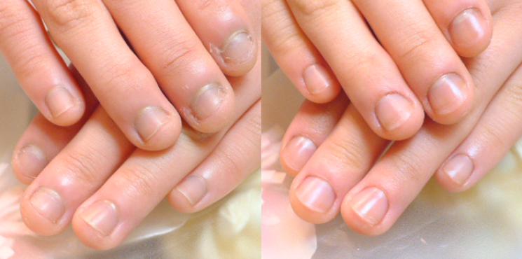 初回 長さ出し2㎜（クリア）のビフォーアフター実例