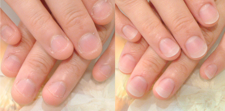 初回 長さ出し3㎜（クリア＋乳白色）のビフォーアフター実例