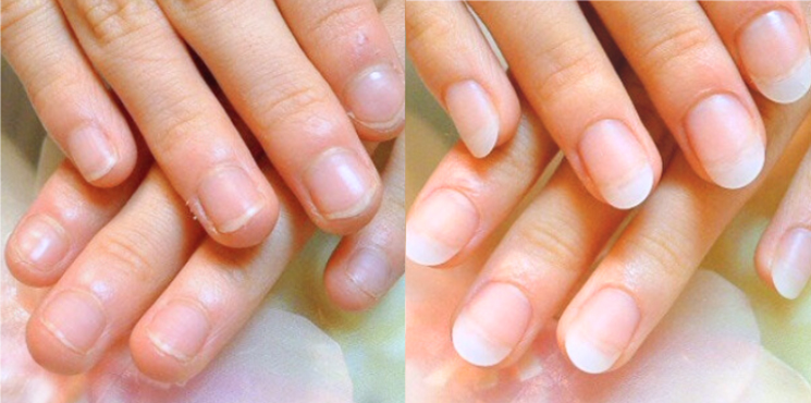 初回 長さ出し5㎜（クリア＋乳白色）のビフォーアフター実例