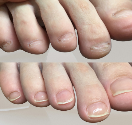 フット 深爪矯正のビフォーアフター実例