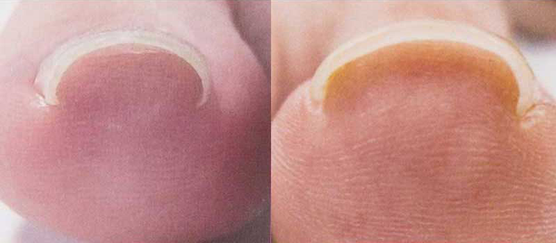 巻爪矯正 ビフォーアフター実例