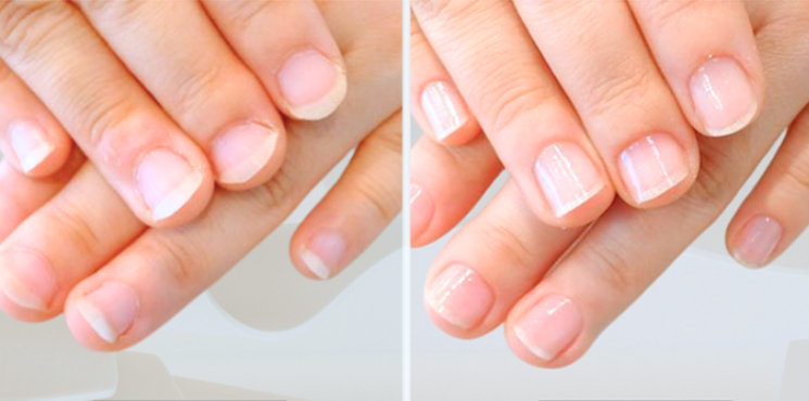 自爪育成 初回〜4ヶ月目の経過実例