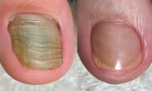 爪甲鉤彎症／肥厚爪 ビフォーアフター実例1