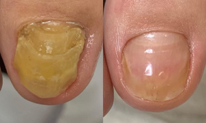 爪甲鉤彎症／肥厚爪 ビフォーアフター実例2