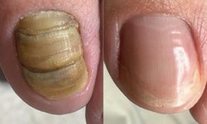 爪甲鉤彎症／肥厚爪 ビフォーアフター実例4