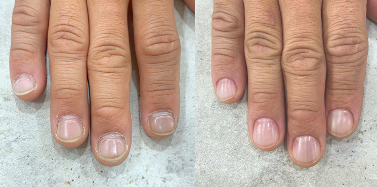 他店修正 アクリル深爪矯正のビフォーアフター実例2