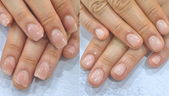 他店修正 アクリル深爪矯正のビフォーアフター実例2