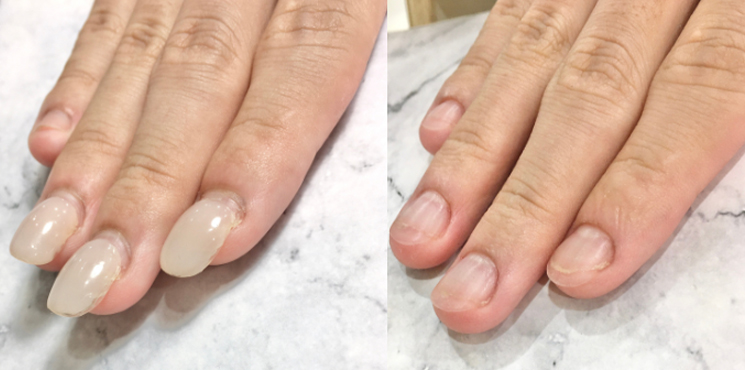 他店修正 アクリル深爪矯正のビフォーアフター実例3