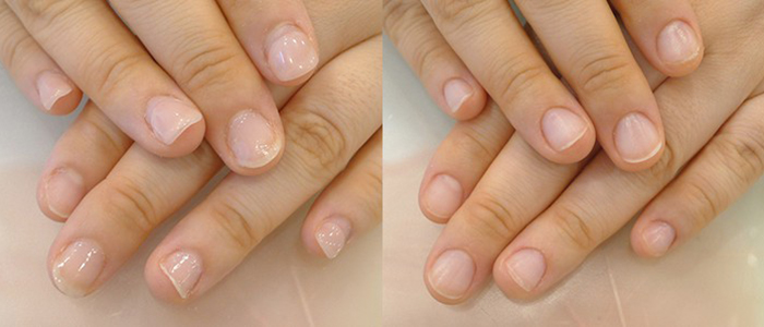 他店修正 ジェル深爪矯正のビフォーアフター実例1