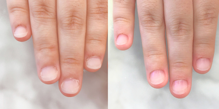 他店修正 ジェル深爪矯正のビフォーアフター実例2