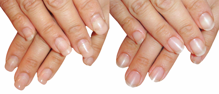 他店修正 ジェル深爪矯正のビフォーアフター実例3