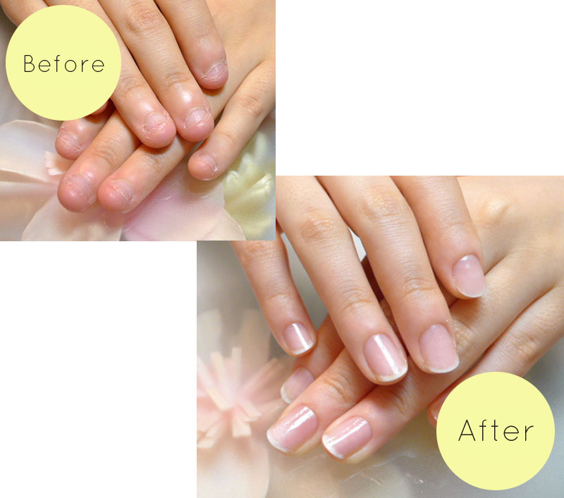 深爪矯正のビフォーアフター実例